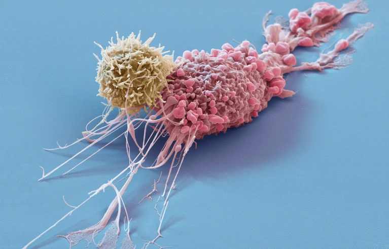 Engineered immune cells, called CAR T cells (yellow), have revolutionized treatment for some tumours (pink) and show promise for treating autoimmune conditions. Credit: Eye Of Science/Science Photo Library